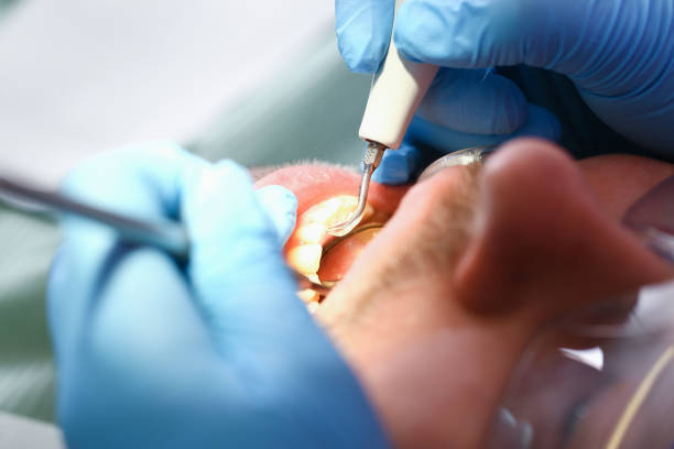 Best Emergency Tooth Extraction in Ardmore, AL